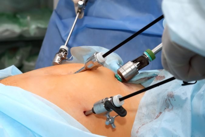 Laparoscopic Hysterectomy Surgery