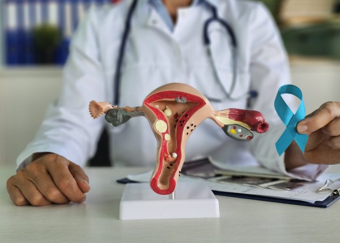 Gynecologist and female reproductive system model and shows turquoise ribbon to raise awareness of ovarian cancer in clinic. Oncology cancer uterus